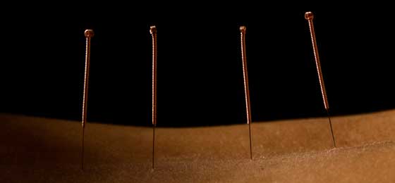 acupuncture needles relieve pain